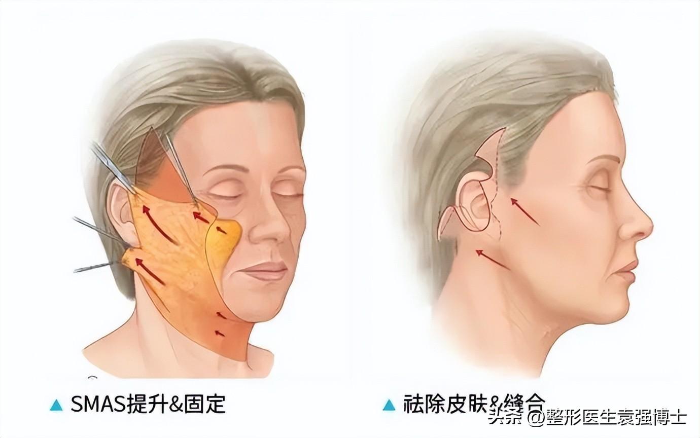 关于拉皮手术后遗症、疤痕、疼痛、恢复，医生说这篇文章都讲到了