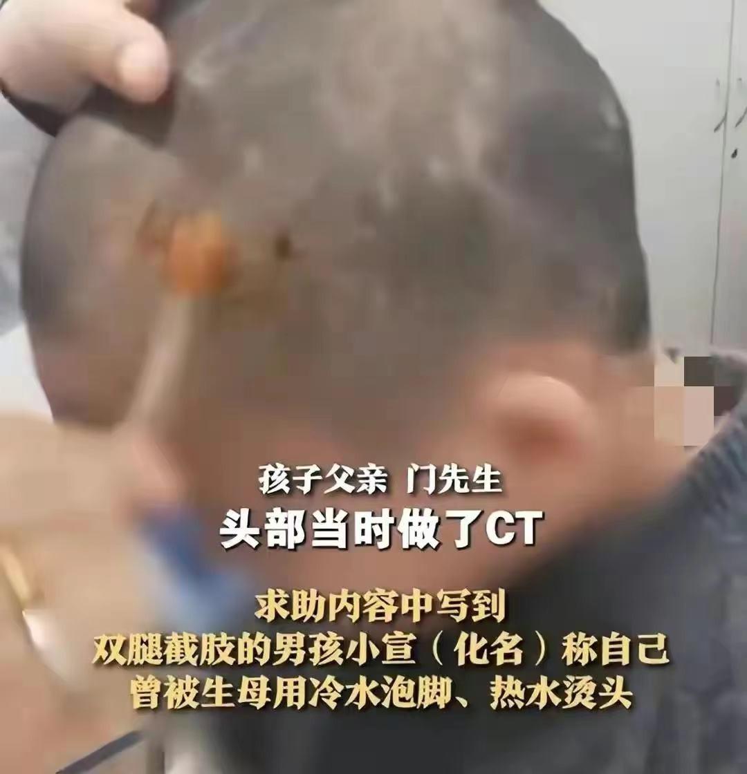 江苏5岁男童被母亲虐待致截肢！亲生父母，为何是虐童主力军？