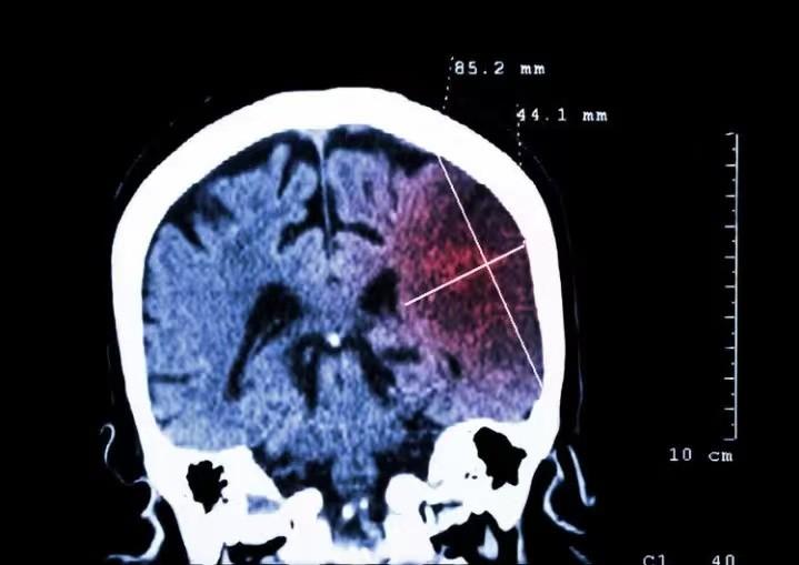 致死率高达80%的脑梗，睡觉先知！睡觉时五个异常，可能是预警