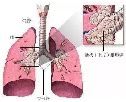 最厉害的癌症，为什么一发现就是晚期？3个早期症状不要再忽视