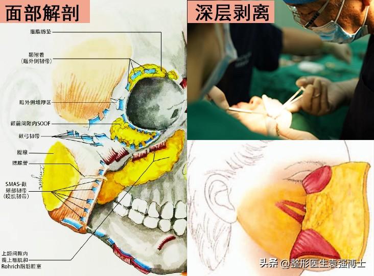 拉皮不只是把皮肤拉起来！这样做，才能杜绝醒目的疤痕