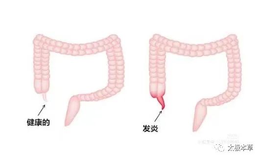 大黄牡丹汤，专用于急性阑尾炎及胆囊炎、胰腺炎及胰腺囊肿、粘连性肠梗阻、卵巢囊肿、内痔