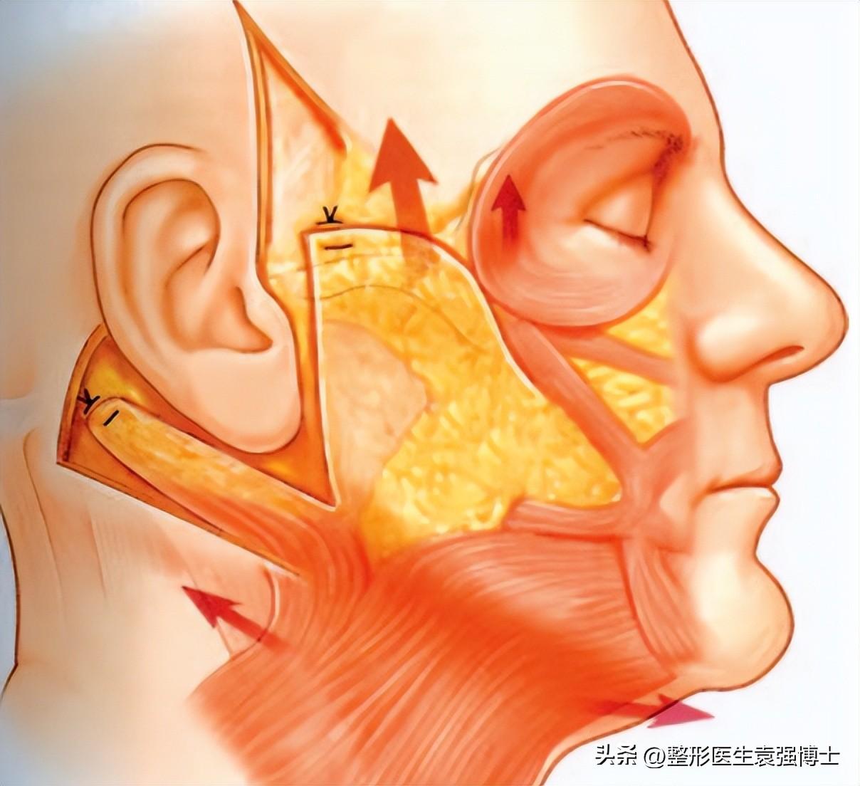 拉皮手术不但会破坏神经，还会加速皮肤下垂？医生说句实话