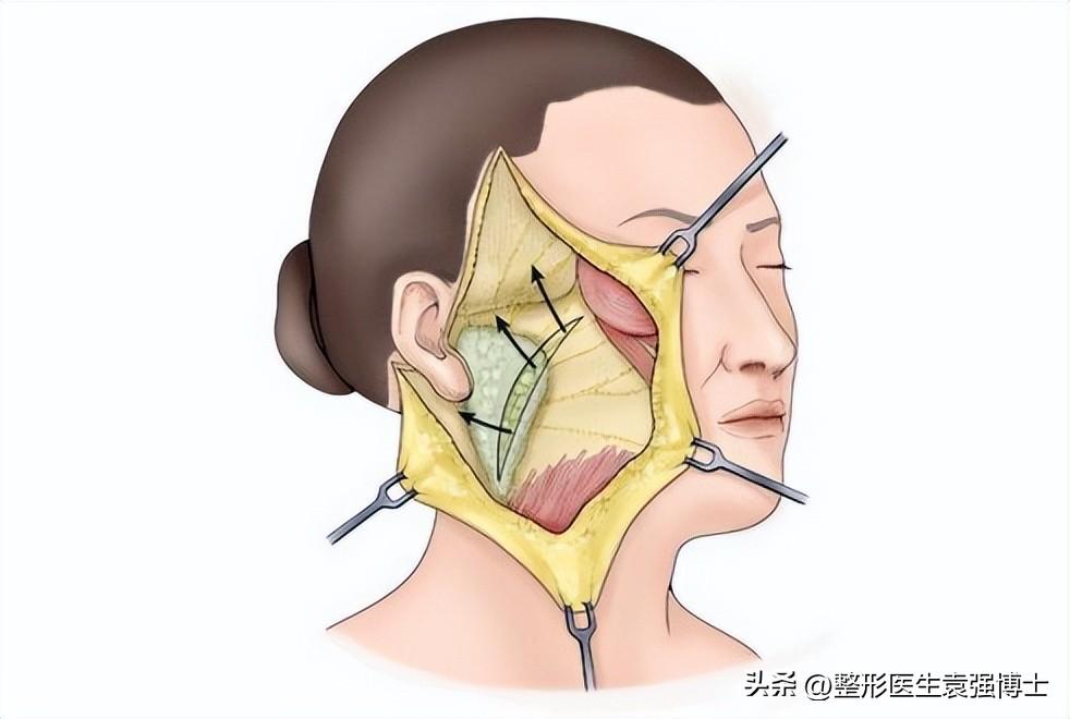 拉皮手术也有“真假”？不了解清楚千万别做，小心踩坑！