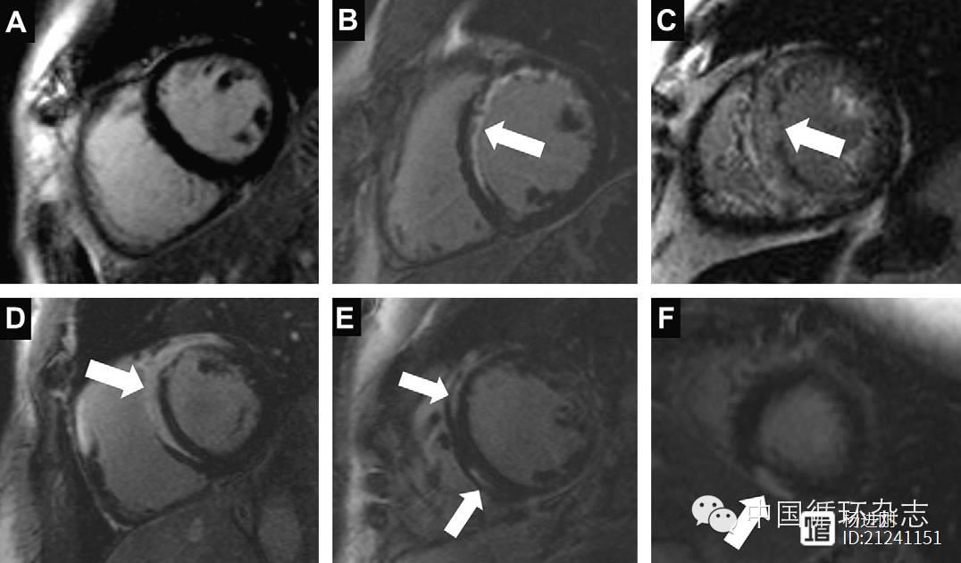 【本刊精选】核磁共振或可成为心衰患者的常规检查？