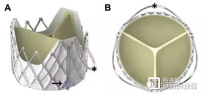 中山医院王春生团队JACC介入子刊撰文称：经心尖置入国产J-Valve瓣膜治疗重度主动脉瓣返流效果可靠