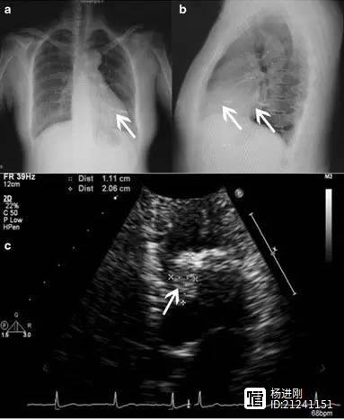 阜外医院病例：心脏上的针
