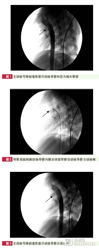 小于1 mm的动脉导管未闭怎么治？河北医大学者有新手段