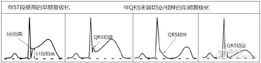 AHA早期复极化科学声明十大要点：J点抬高但ST段水平或下降与特发室颤有关