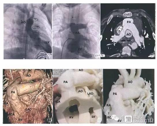 【量体裁衣 度身定做】阜外医院3D打印指导治疗心脏病经验