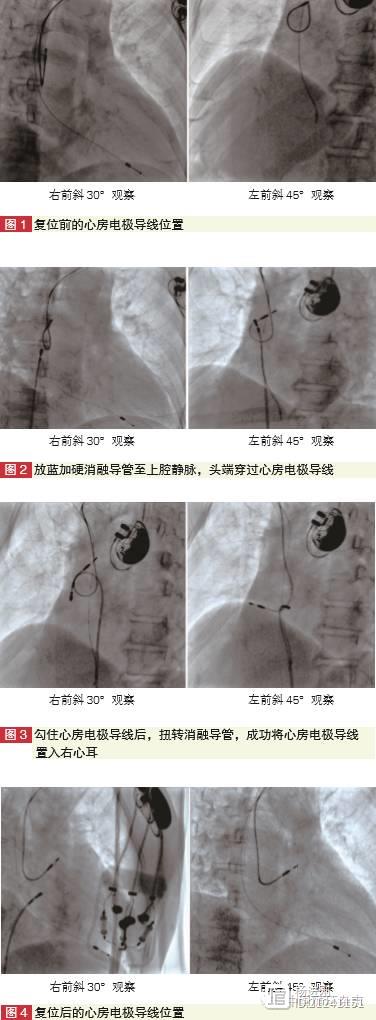 浙大一院学者新法巧治起搏器电极脱位