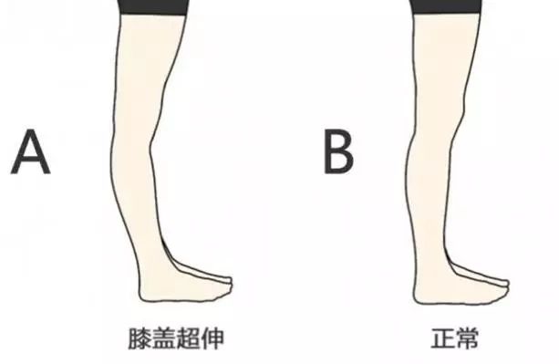 膝盖超伸太多？一招教你解决这个问题