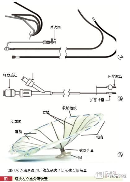 厦门市心血管病医院王焱等报告18例Parachute伞治疗室壁瘤性缺血性心衰，3个月随访安全有效