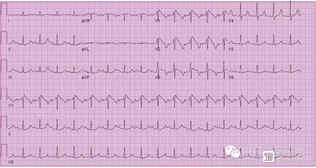 【ACC专科培训之心电图每月一练】晕厥的亚裔大学生