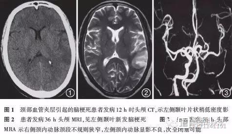 50岁女士脑梗为那般？原是擀面杖按摩惹的祸