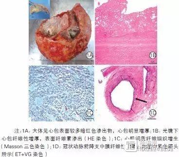 【阜外医院病理科报告】放疗后应警惕放射性心肌损伤，或致心肌纤维化和心包炎