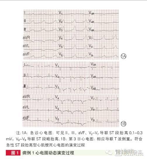 【病例讨论】小面积梗死为何也可致广泛ST段抬高？