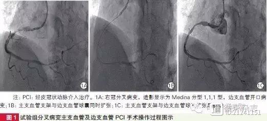 兰州大学一院张钲等：边支血管预扩球囊保护边支血管经验