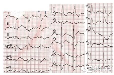 【阜外医院病例讨论】V1~V3 导联ST 段抬高也可为右室梗死表现