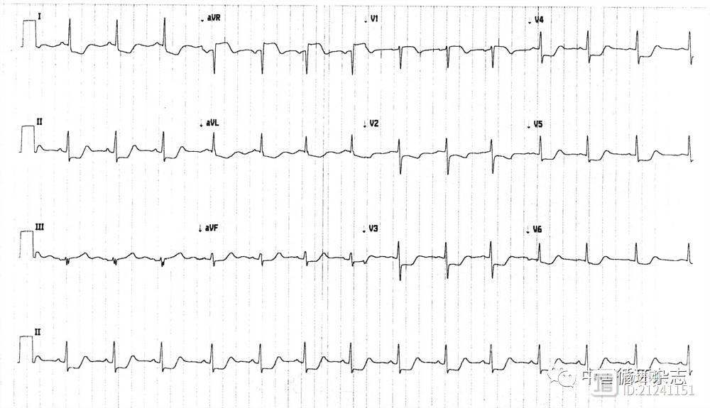 【ACC心电图每周一练】产后胸痛伴ST段抬高的年轻女性
