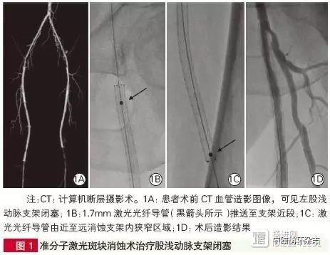 阜外医院蒋雄京等在国内率先开展联合激光消蚀治疗下肢动脉疾病