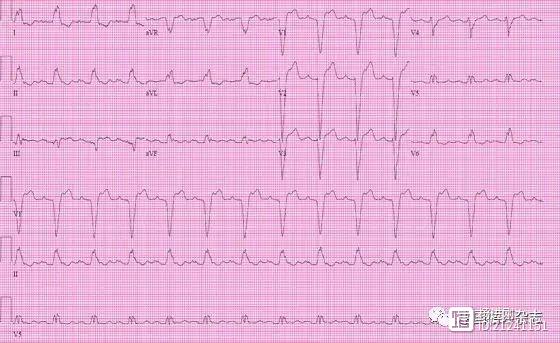 【ACC心电图每周一练】心悸、呼吸困难的患者ST-T改变是缺血吗？