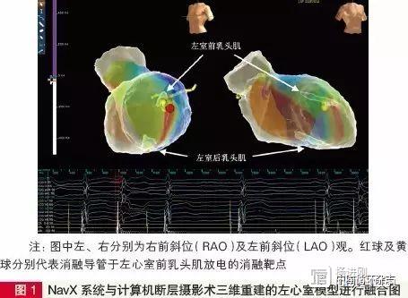 阜外医院姚焰等融合CT影像与三维标测系统进行了一例消融，称极大提高了消融精确性