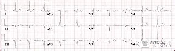 【ACC心电图每周一练】心电图表现为前壁和下壁心肌梗死的年轻女性