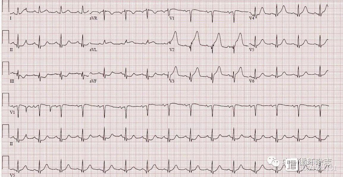 【ACC心电图每周一练】ST段抬高型心肌梗死患者合并严重血小板减少症