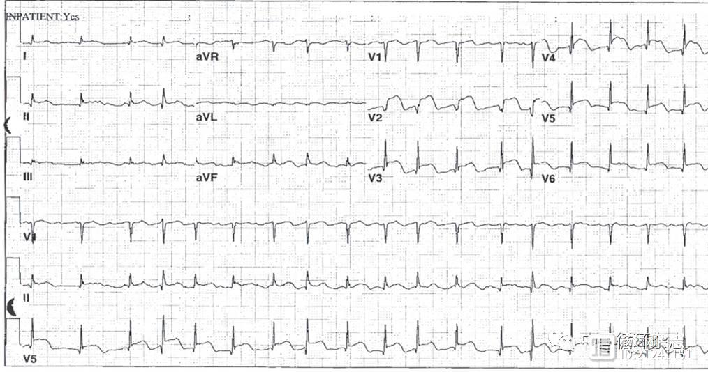 【ACC每周心电图一练】一例容易误诊的典型病例：老年糖尿病女士恶心上腹部疼痛