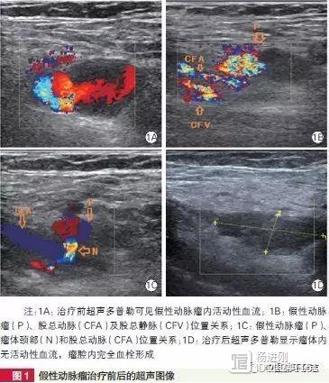 阜外医院姚焰等报告，超声引导处理股动脉假性动脉瘤成功率高