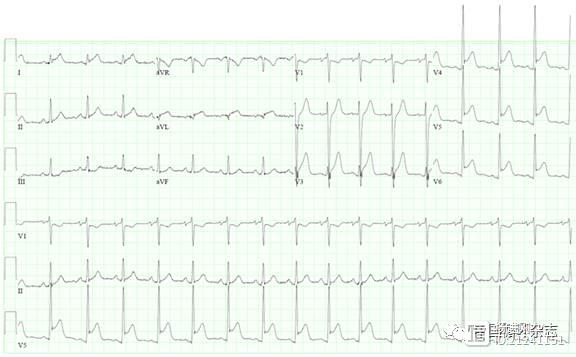 【ACC每周心电图一练】17岁的胸痛患者