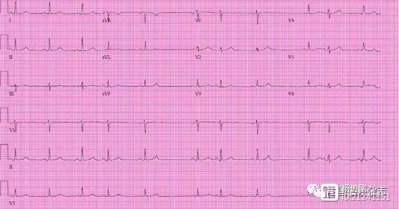 【ACC心电图每周一练】 简单的心电图不简单