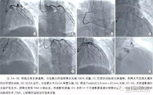 阜外医院新技术治疗闭塞病变，准分子激光可消蚀机化血栓、结缔组织和钙化