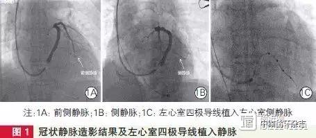 心衰患者的好消息：阜外医院用四极导线再同步化治疗心衰