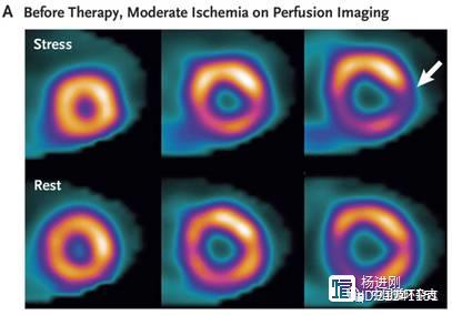 新英格兰医学杂志：眼见为实！高强度他汀和依折麦布等逆转冠脉严重狭窄