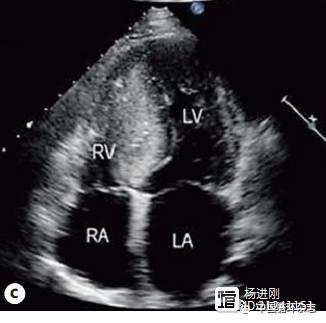 阜外医院樊朝美等在Cardiology杂志发表研究，带你了解极度右室肥厚型心肌病