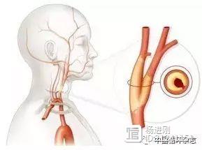 天坛医院王拥军等研究称，有≥2个颈动脉斑块者，痴呆风险高