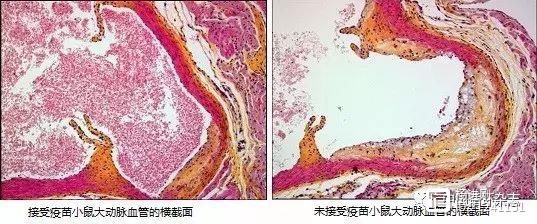 欧洲已启动高胆固醇血症疫苗1期临床试验