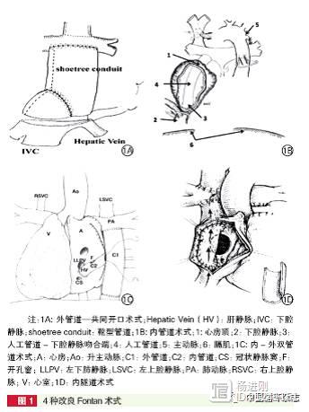 阜外医院闫军等报告，改良Fontan术治疗肝静脉直接入心房单心室患者效果好