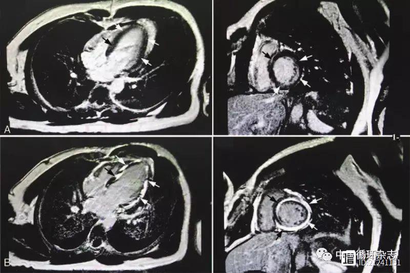 阜外医院杨艳敏等总结ST段抬高心肌炎的患者特征：核磁可见斑片状延迟强化，及时诊治者预后良好