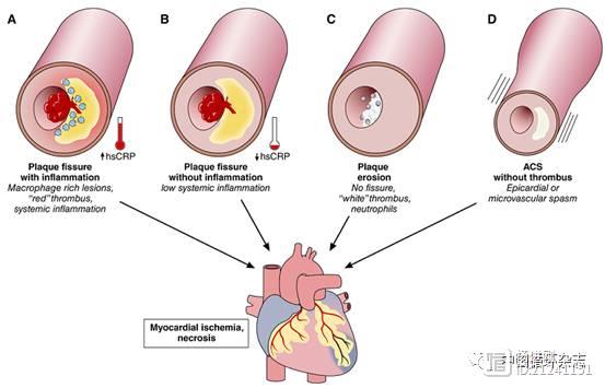 炎症学说开创者Peter Libby提出精准诊疗急性冠脉综合征：根据炎症和影像学可分四种类型