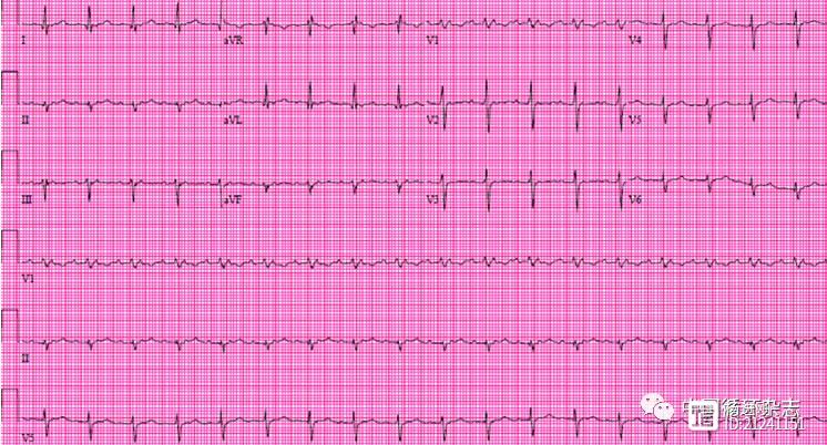ACC心电图病例分析：因倦怠、心悸加重就诊的66岁老年男性