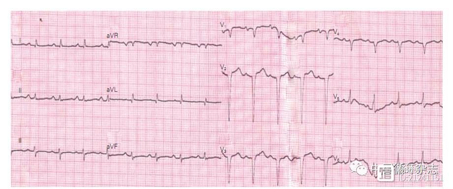 阜外医院赵世华等研究称，有这两种心电图特征应怀疑心肌淀粉样变