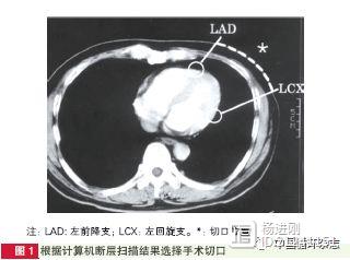 北医三院心外科研究称：小切口双侧乳内动脉不停跳多支血管搭桥近期效果良好