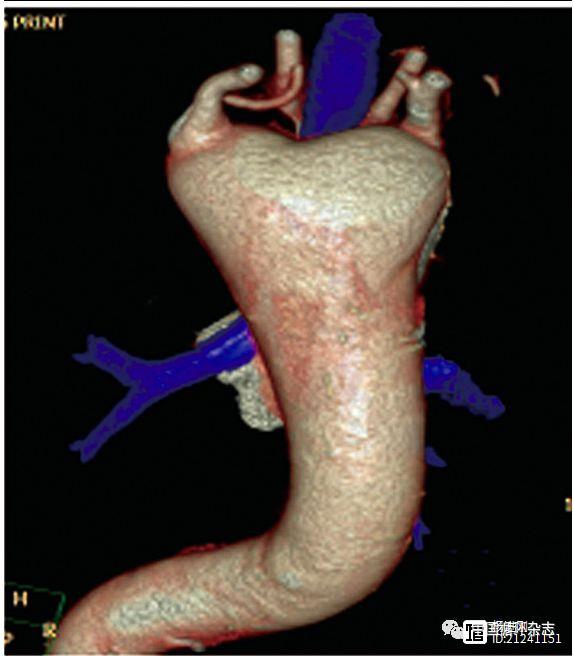 武汉学者称，类似“双头蛇”改变是主动脉憩室的标志性诊断图像