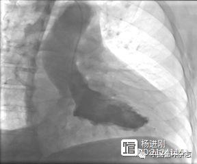 美学者称，心梗后心脏破裂不少见