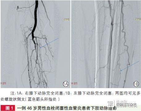 阜外医院蒋雄京等谈血栓闭塞性血管炎：戒烟是阻止进展的主要手段