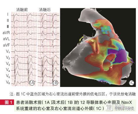 阜外医院治疗Brugada 综合征经验：选择导管消融或能根治