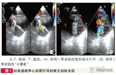 兰大第二医院经验：经超声引导经胸微小切口封堵主动脉夹层可行